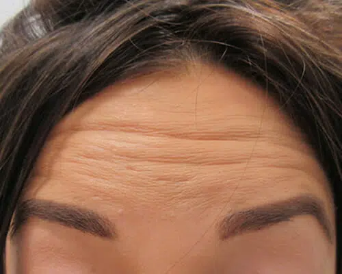 Anti-Wrinkle Injections Manchester and Knutsford, Cheshire