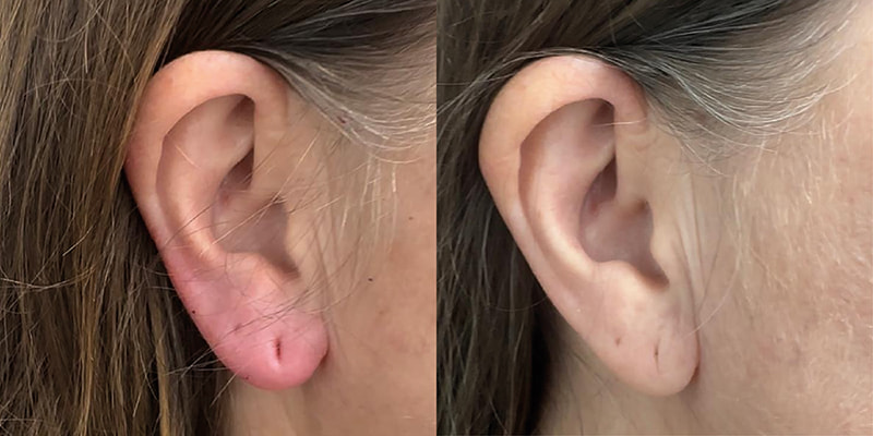 manchester earlobe filler patient before and after