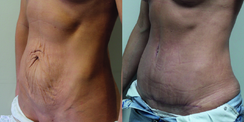 Tummy Tuck Before & After Image