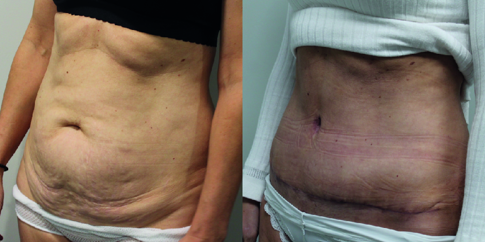 Tummy Tuck Before & After Image