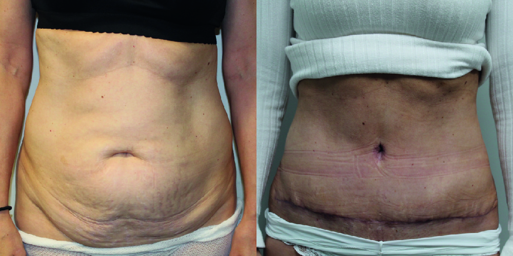 Tummy Tuck Before & After Image