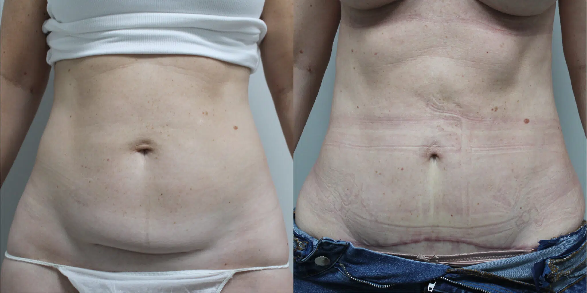 BodyTite Before & After Image