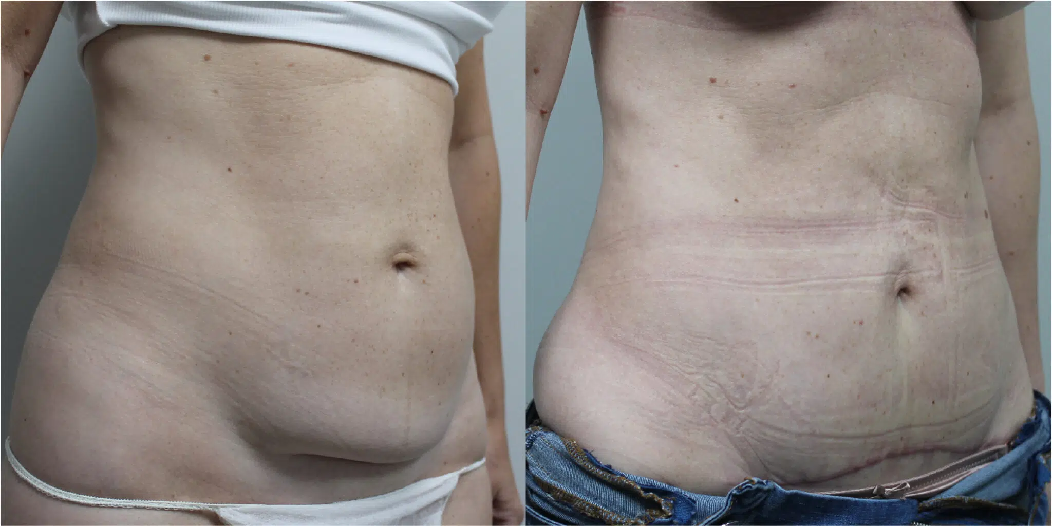 BodyTite Before & After Image