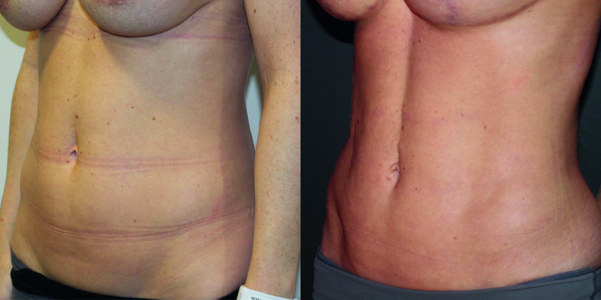 Vaser Before & After Image