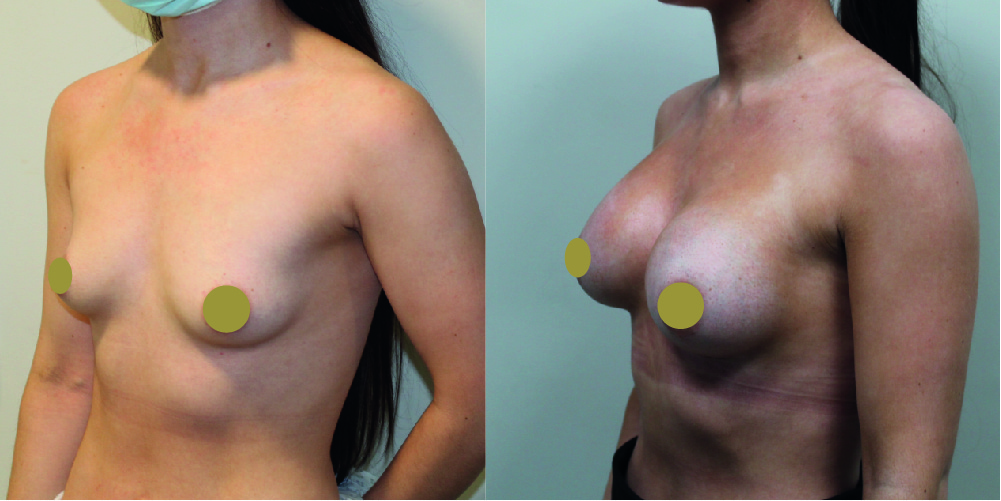 Breast Augmentation Before & After Image