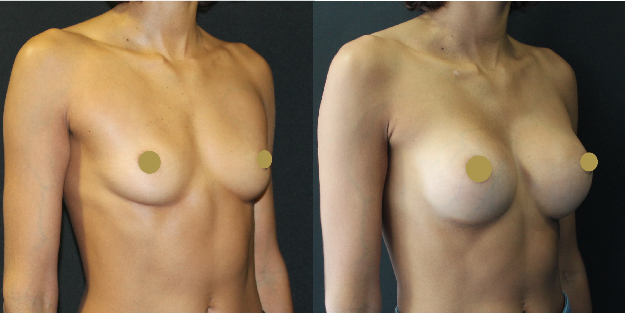 Breast Augmentation Before & After Image