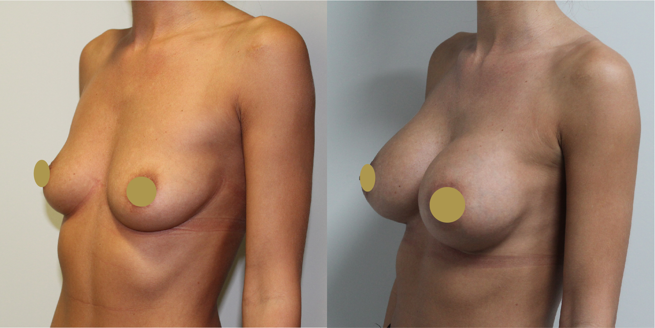 Breast Augmentation Before & After Image