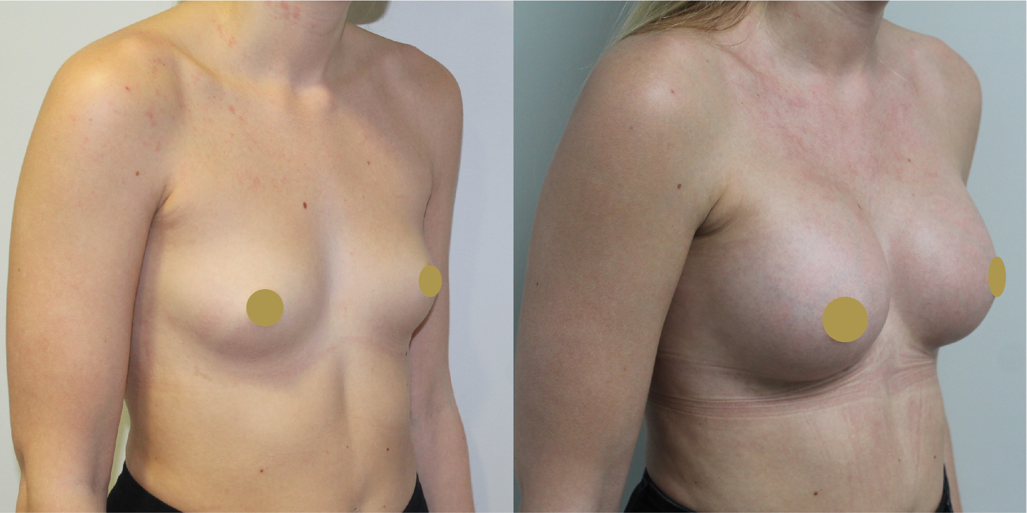 Breast Augmentation Before & After Image