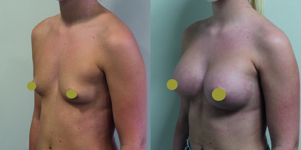 Breast Augmentation Before & After Image