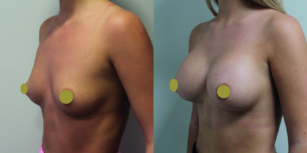 Breast Augmentation Before & After Image