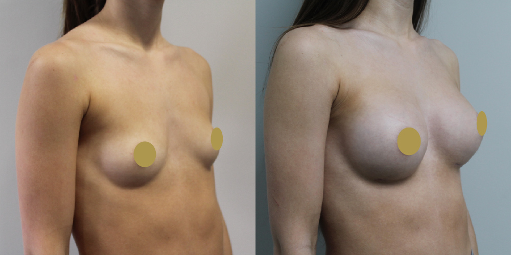 Breast Augmentation Before & After Image