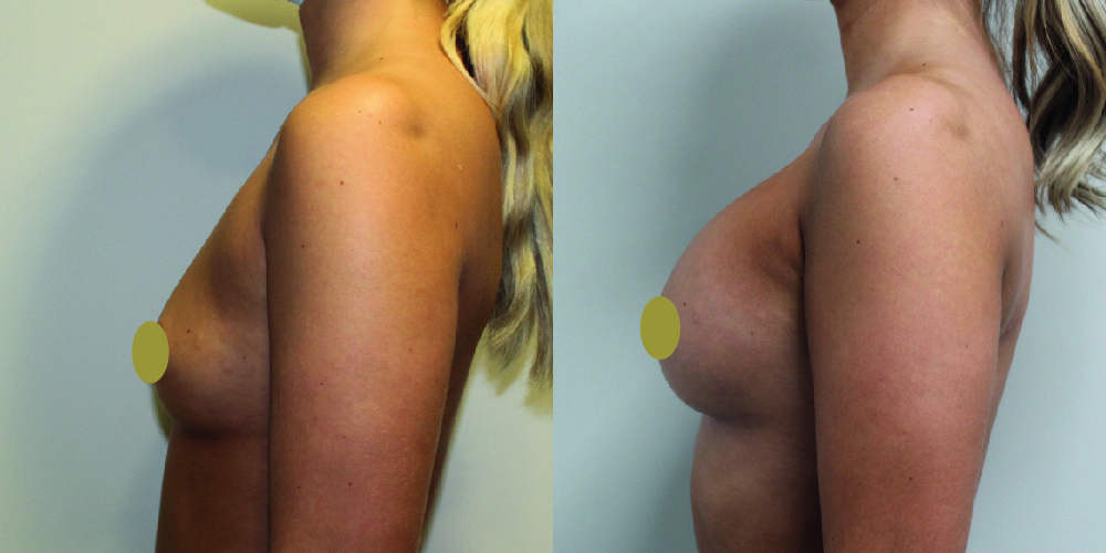 Breast Augmentation Before & After Image