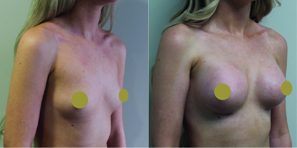 Breast Augmentation Before & After Image