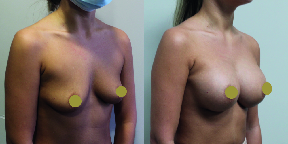 Breast Augmentation Before & After Image