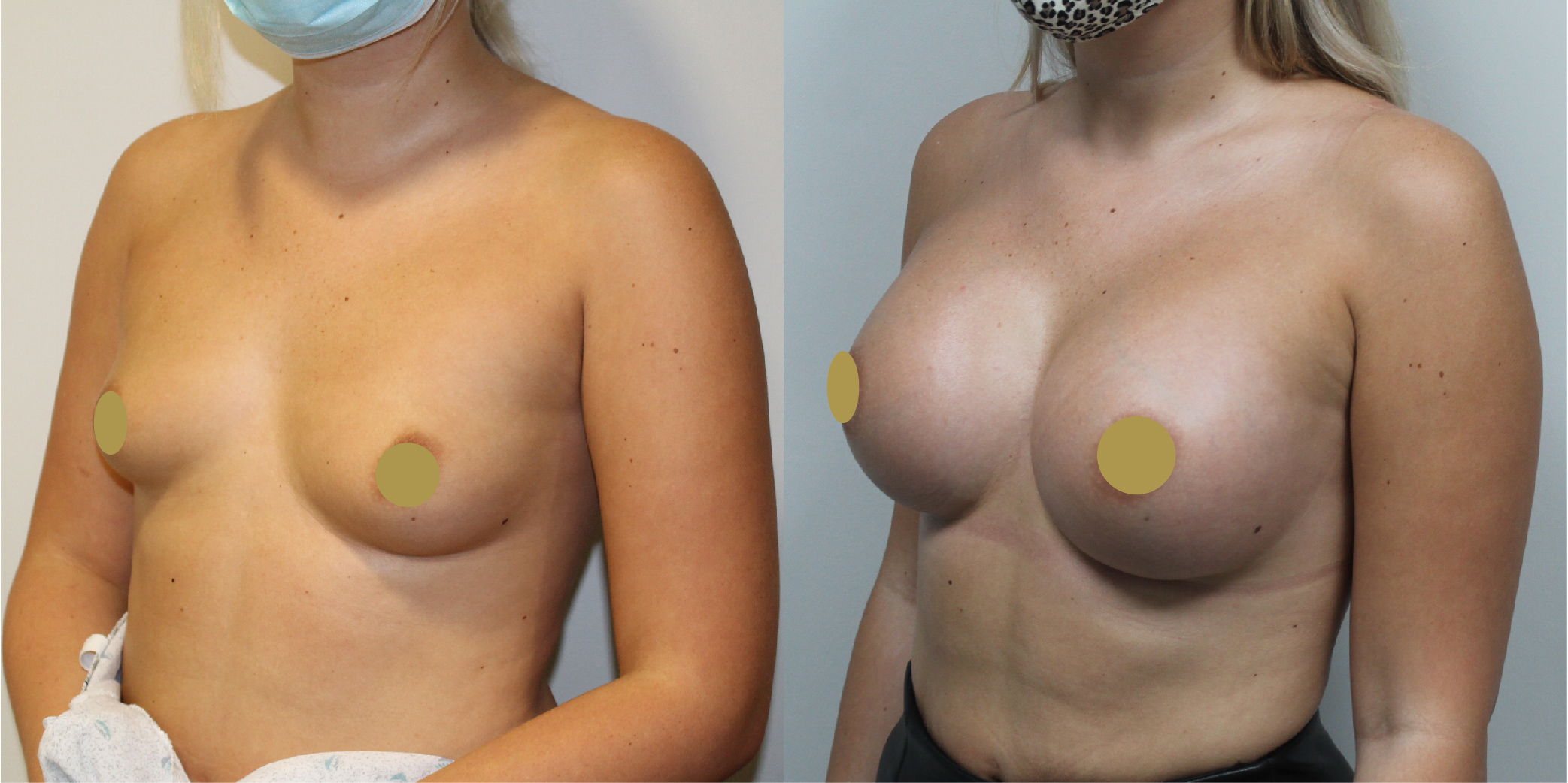 Breast Augmentation Before & After Image