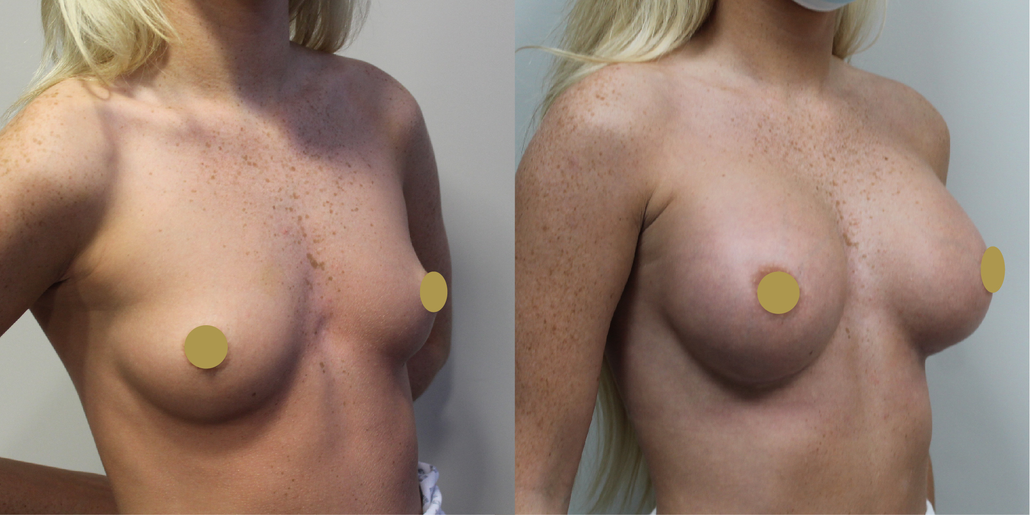 Breast Augmentation Before & After Image