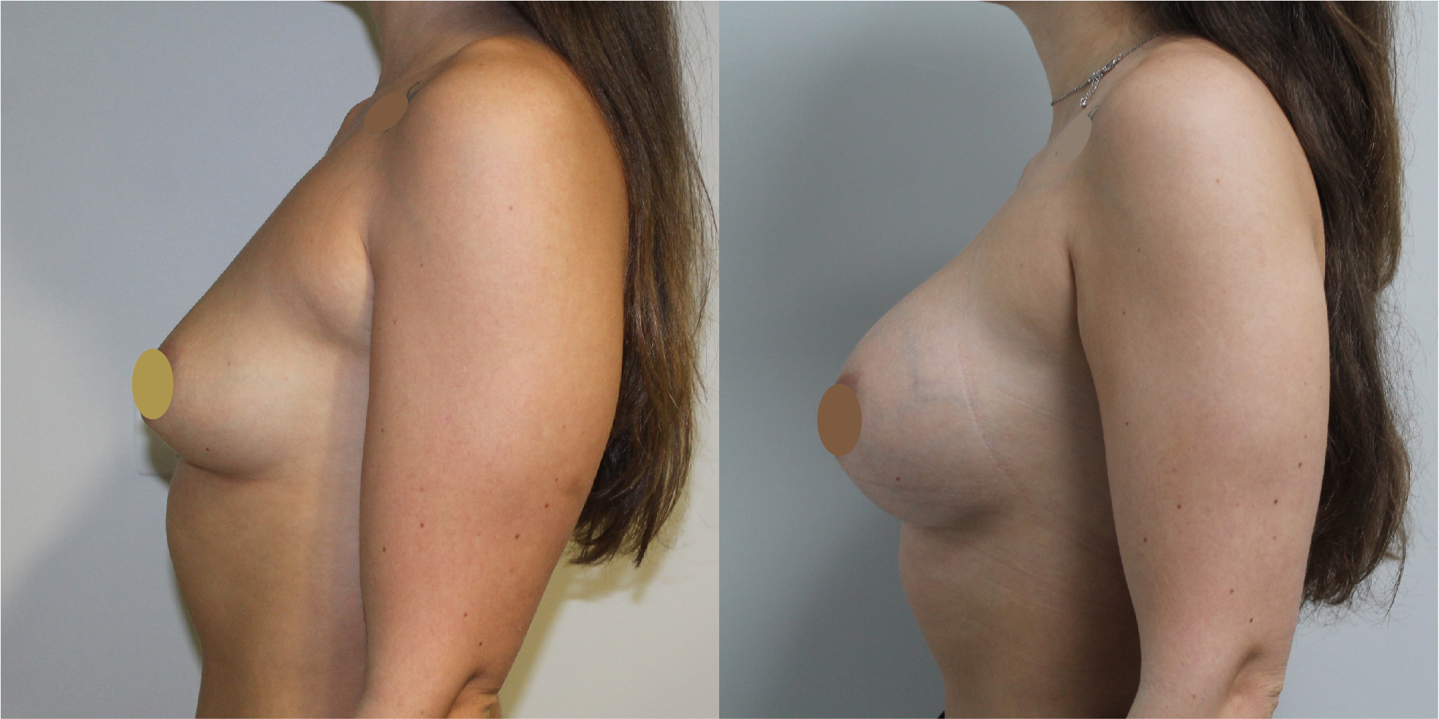 Breast Augmentation Before & After Image