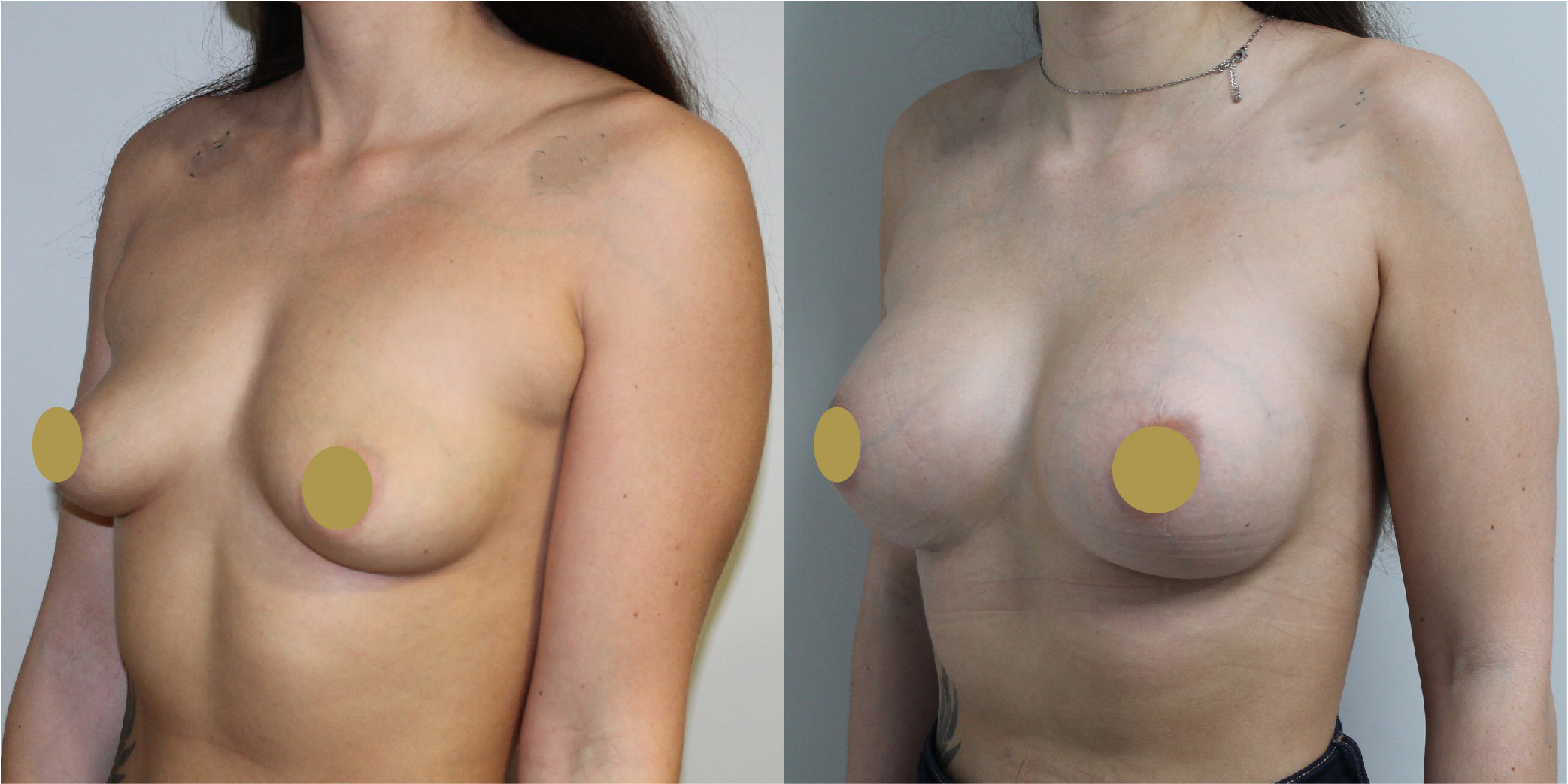 Breast Augmentation Before & After Image