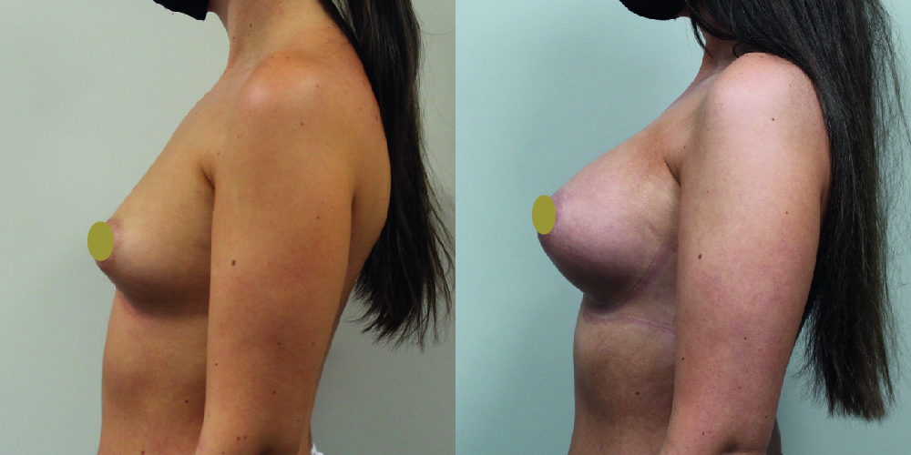 Breast Augmentation Before & After Image