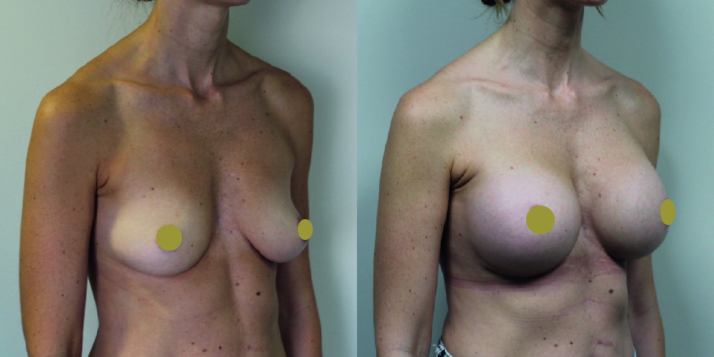 Breast Augmentation Before & After Image