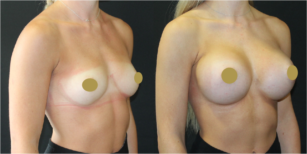 Breast Augmentation Before & After Image