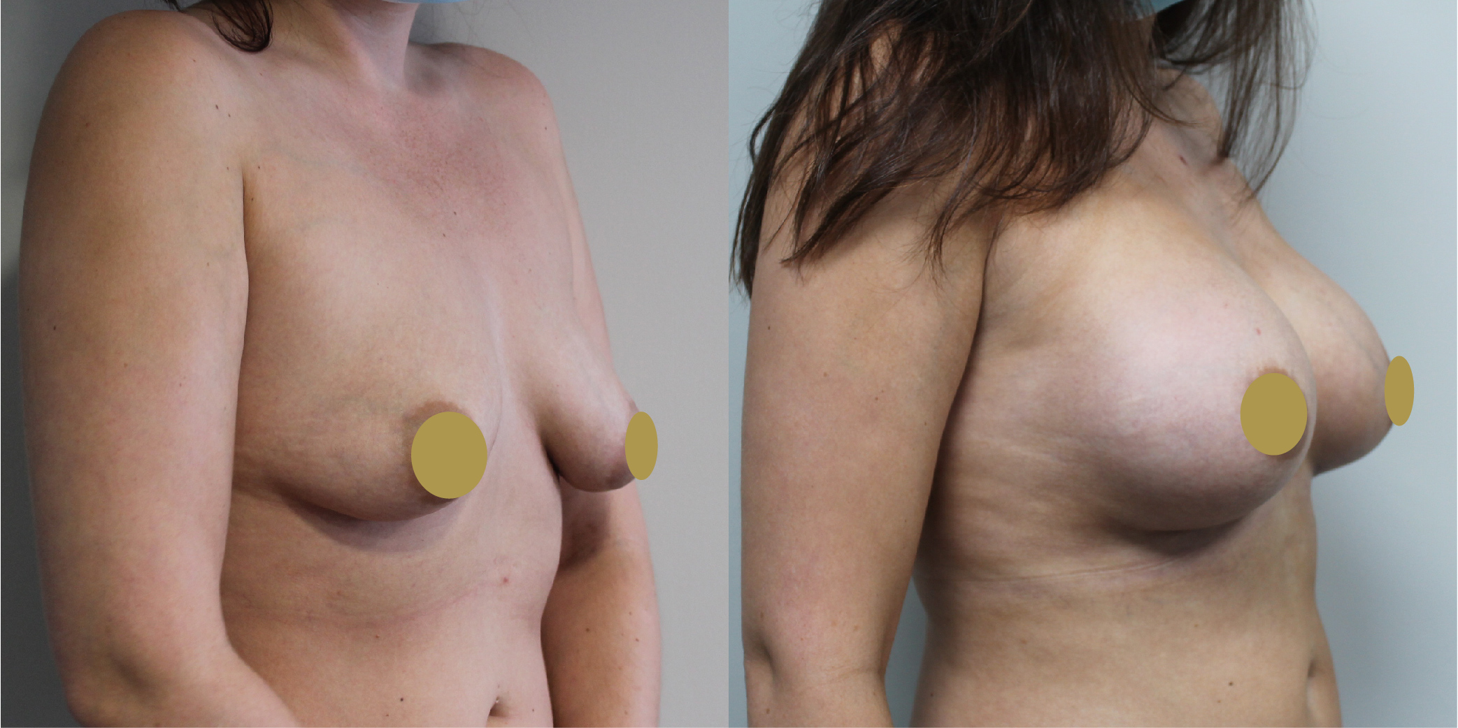 Breast Augmentation Before & After Image