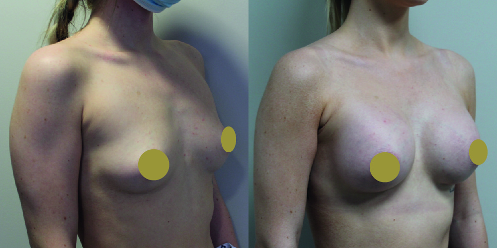 Breast Augmentation Before & After Image