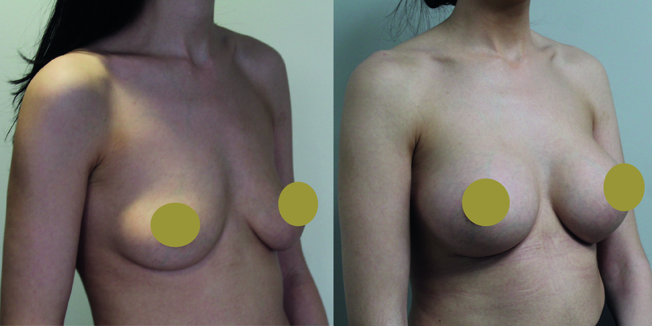 Breast Augmentation Before & After Image