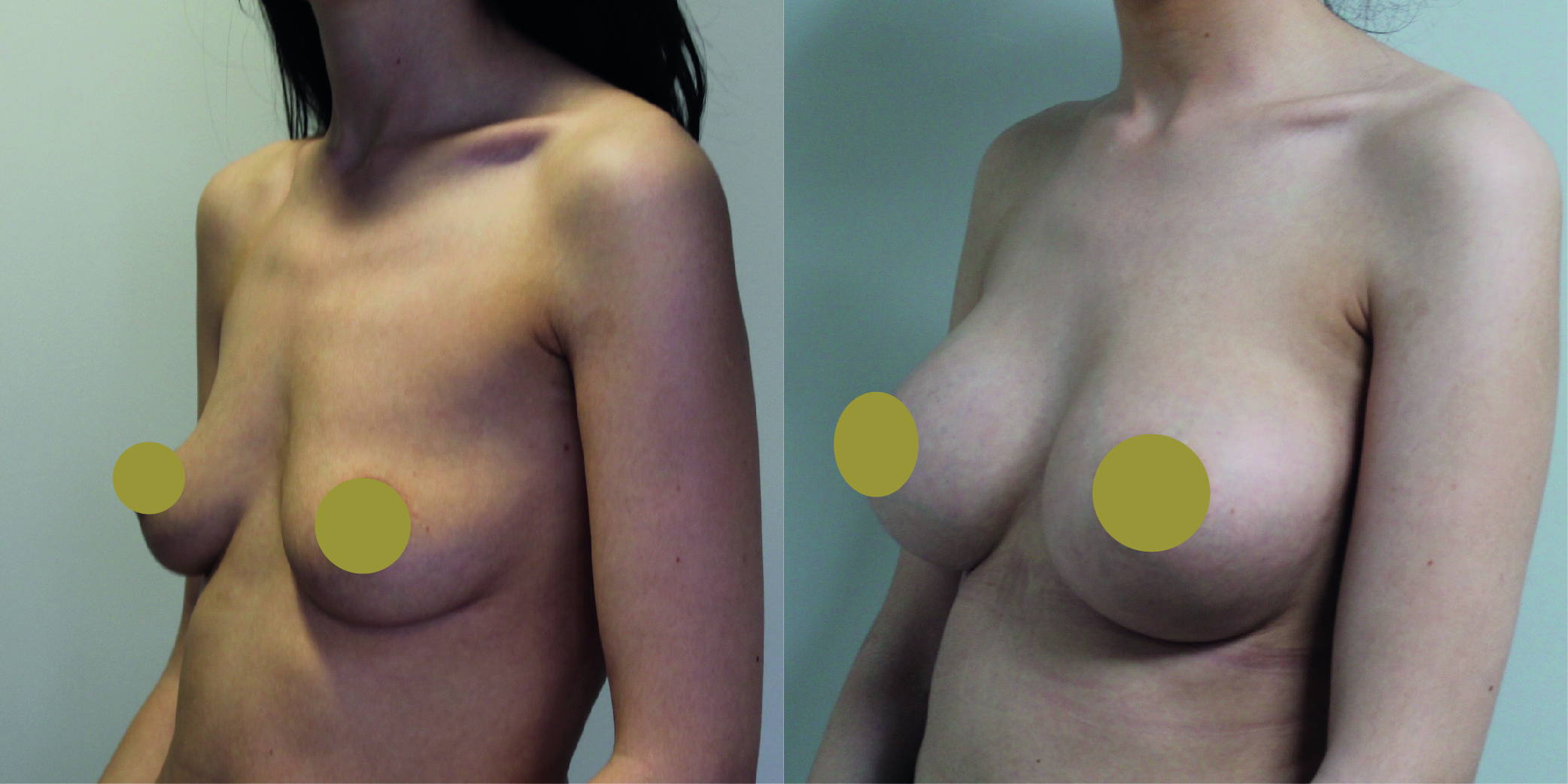 Breast Augmentation Before & After Image