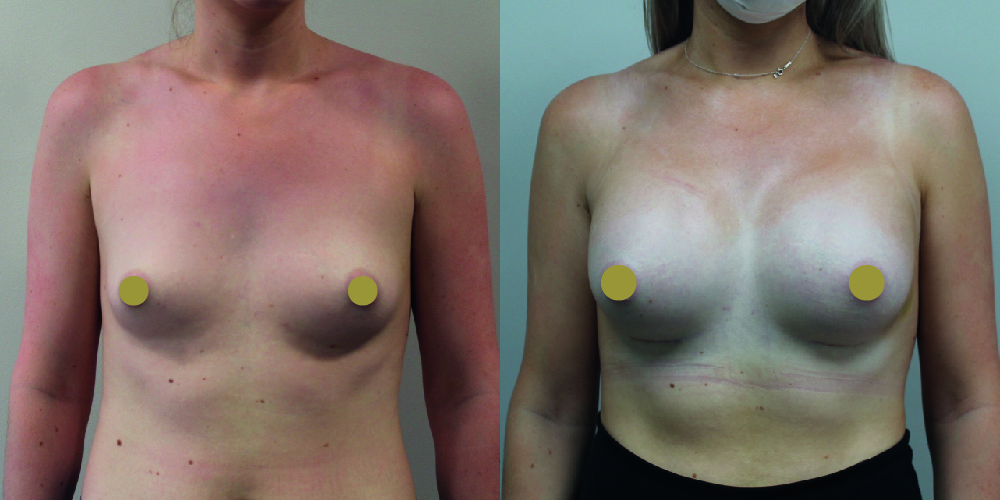 Breast Augmentation Before & After Image