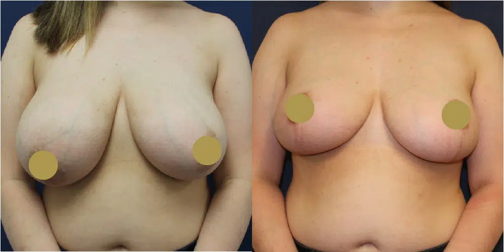 Breast Reduction Before & After Image