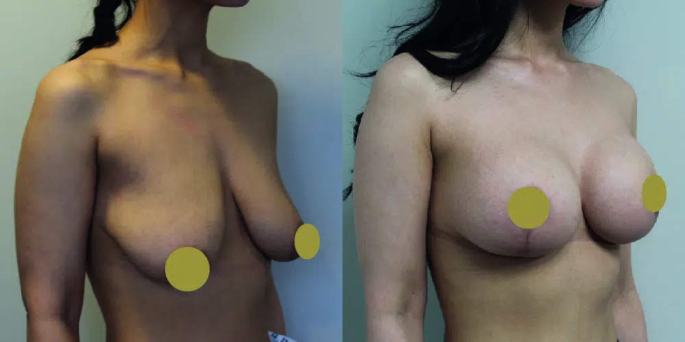 Mastopexy Before & After Image