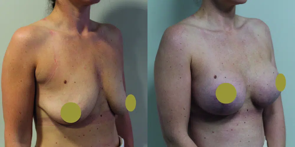 Mastopexy Before & After Image