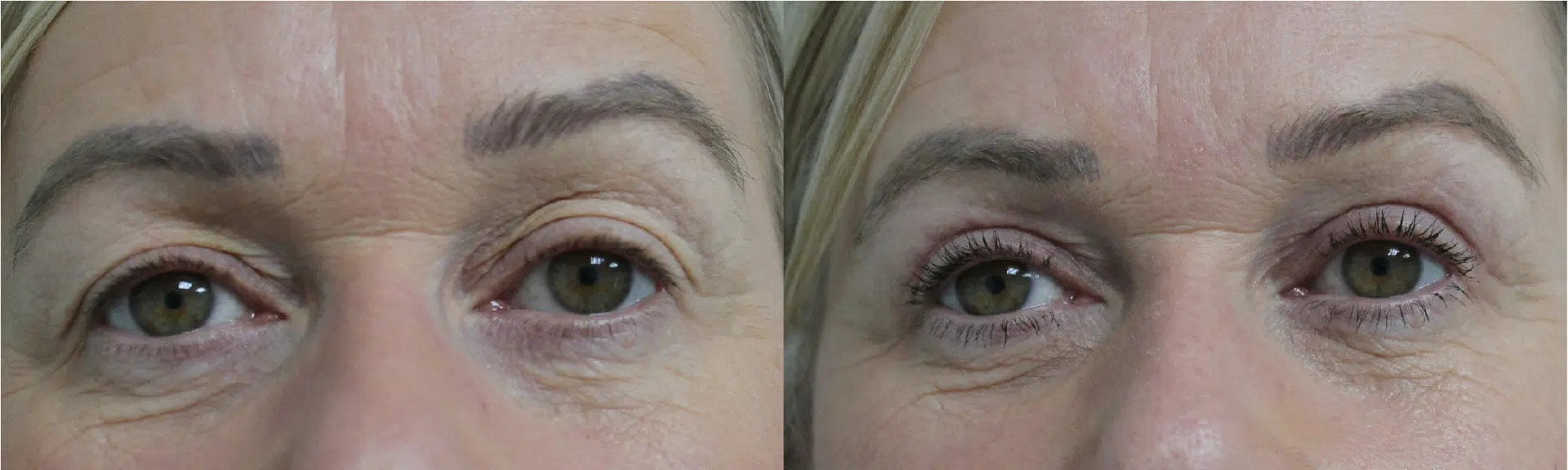 Blepharoplasty Before & After Image