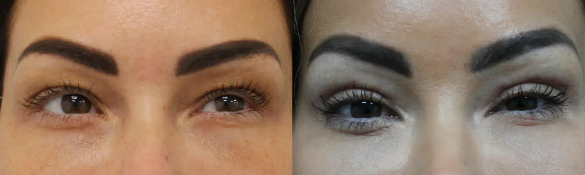 Blepharoplasty Before & After Image