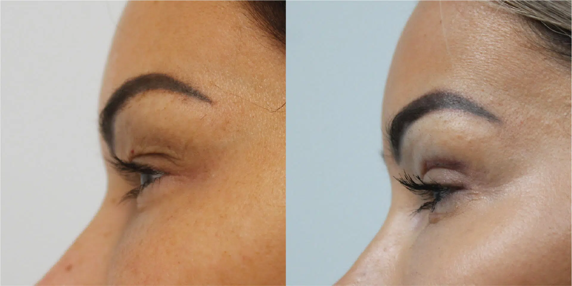 Blepharoplasty Before & After Image