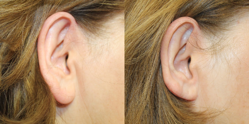 Earlobe Reduction Before & After Image