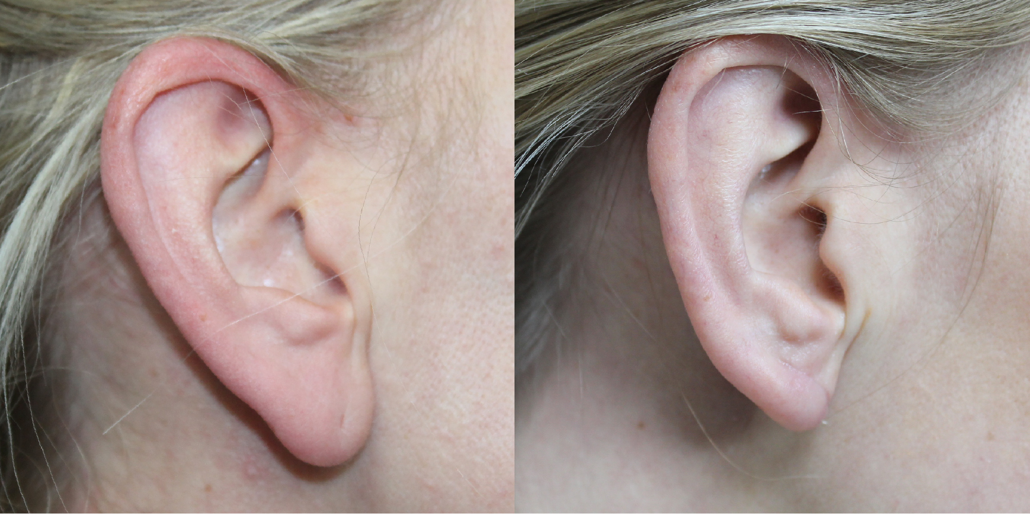 Earlobe Reduction Before & After Image