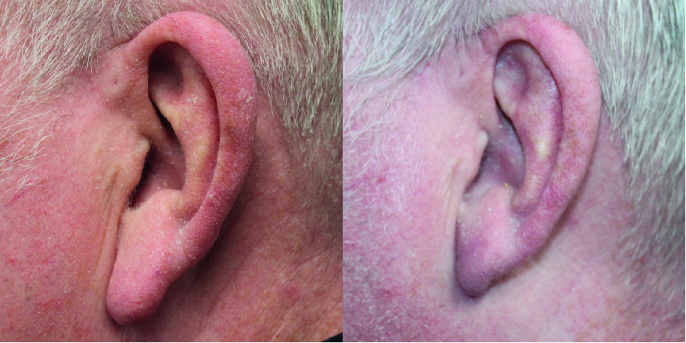 Earlobe Reduction Before & After Image