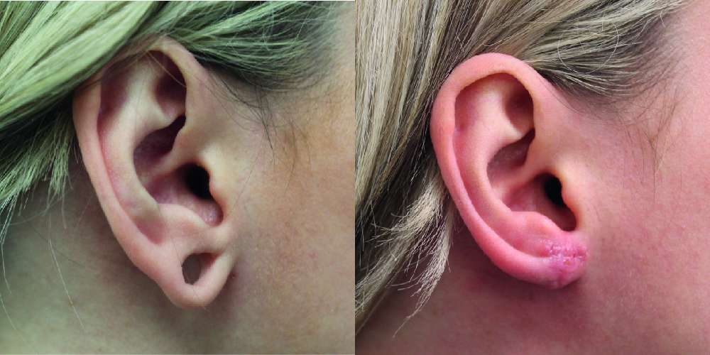 Earlobe Repair Before & After Image