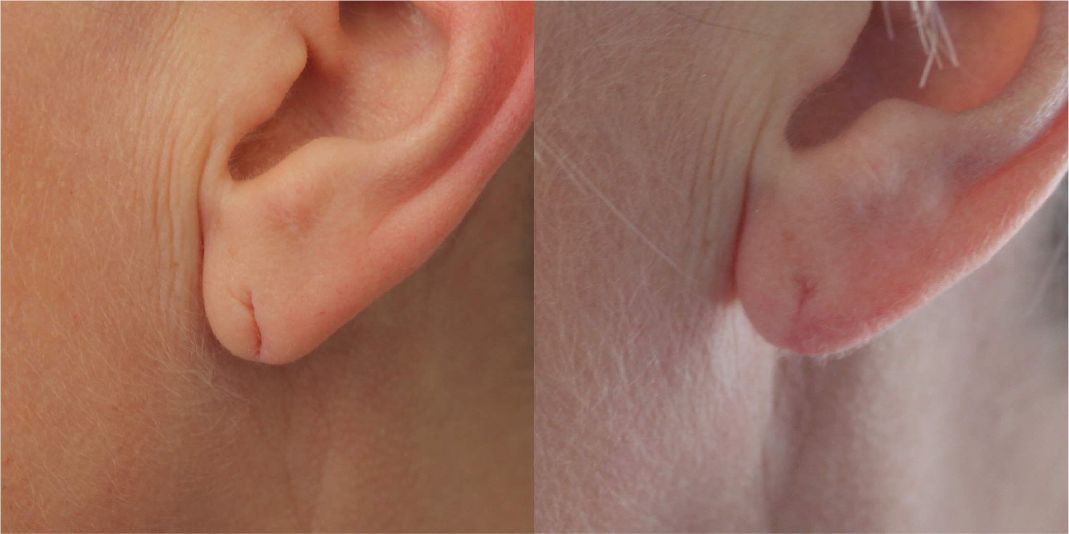 Earlobe Repair Before & After Image