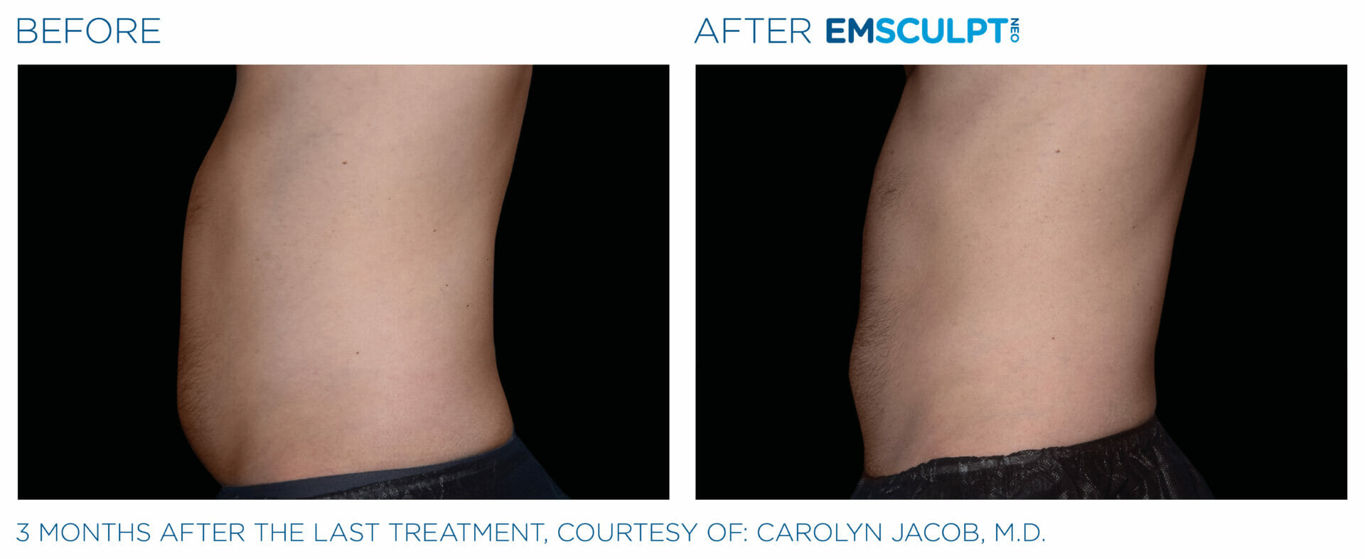 Emsculpt Neo Before & After Image