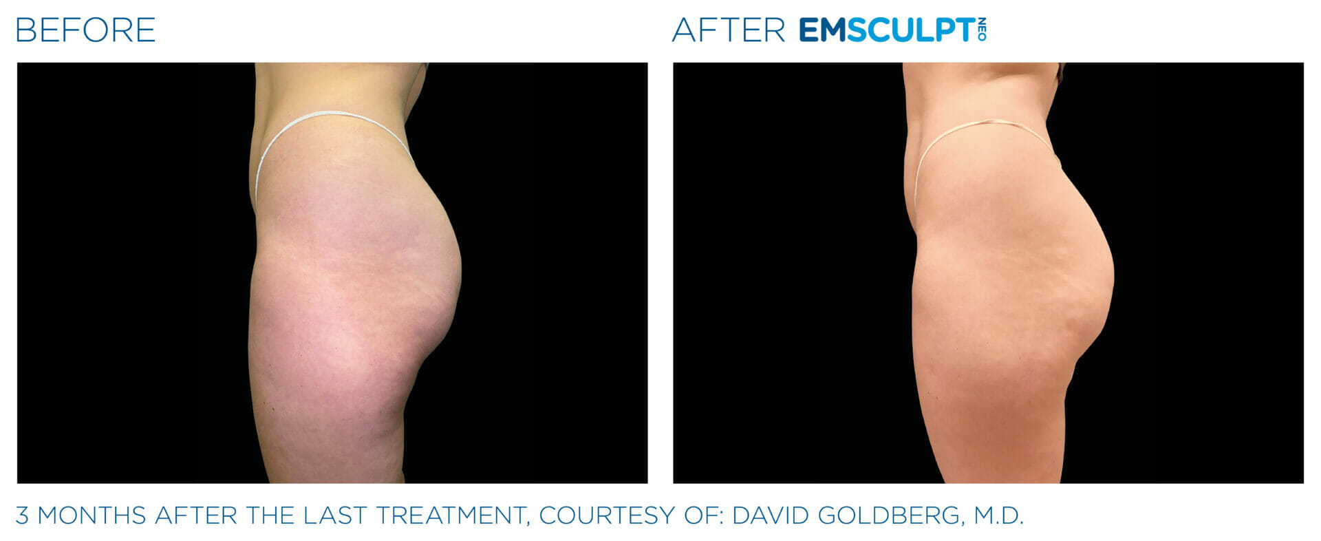 Emsculpt Neo Before & After Image