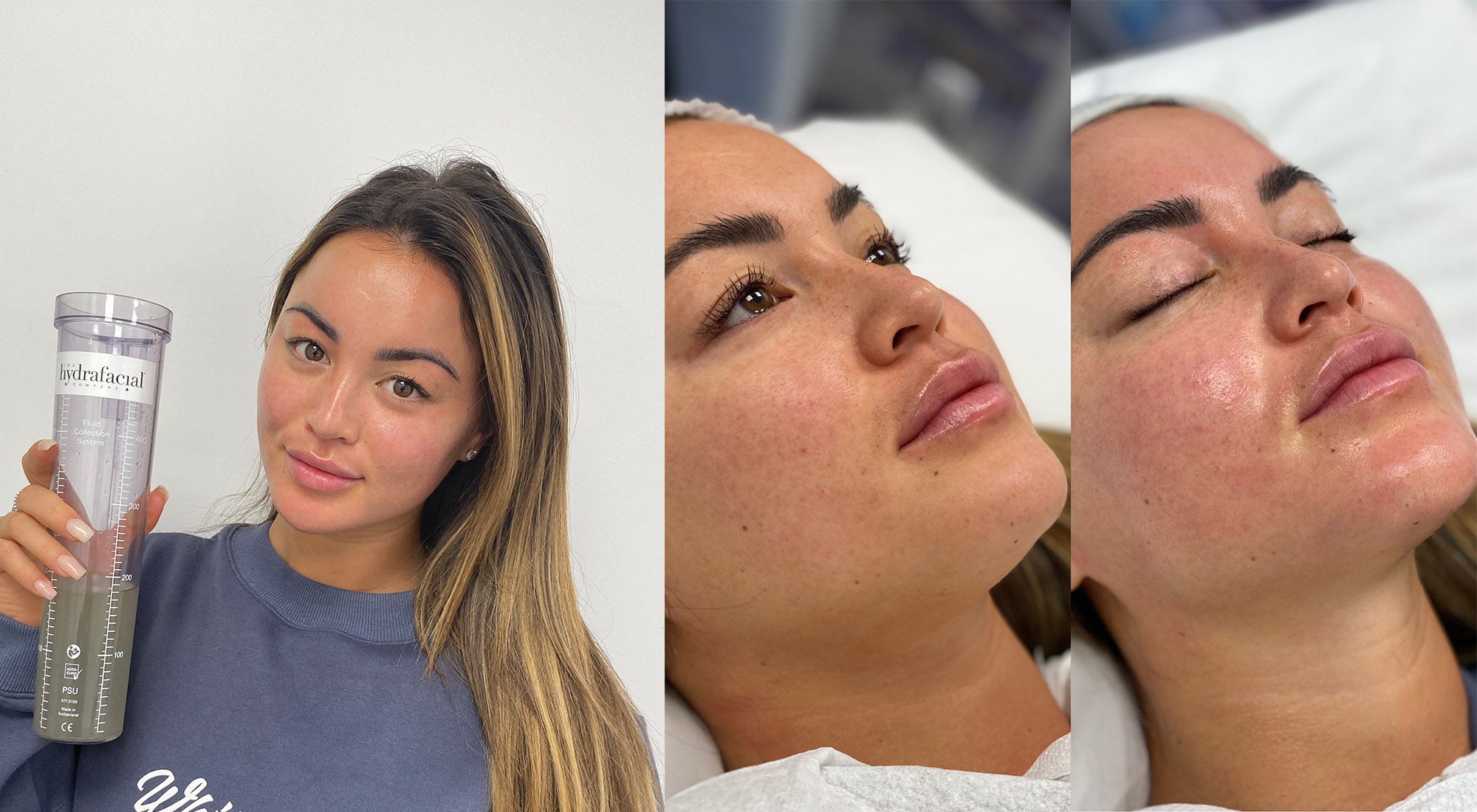 Hydrafacial Before & After Image