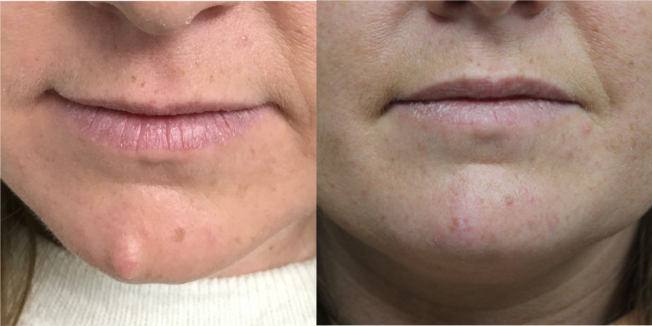 Laser Mole Removal Before & After Image