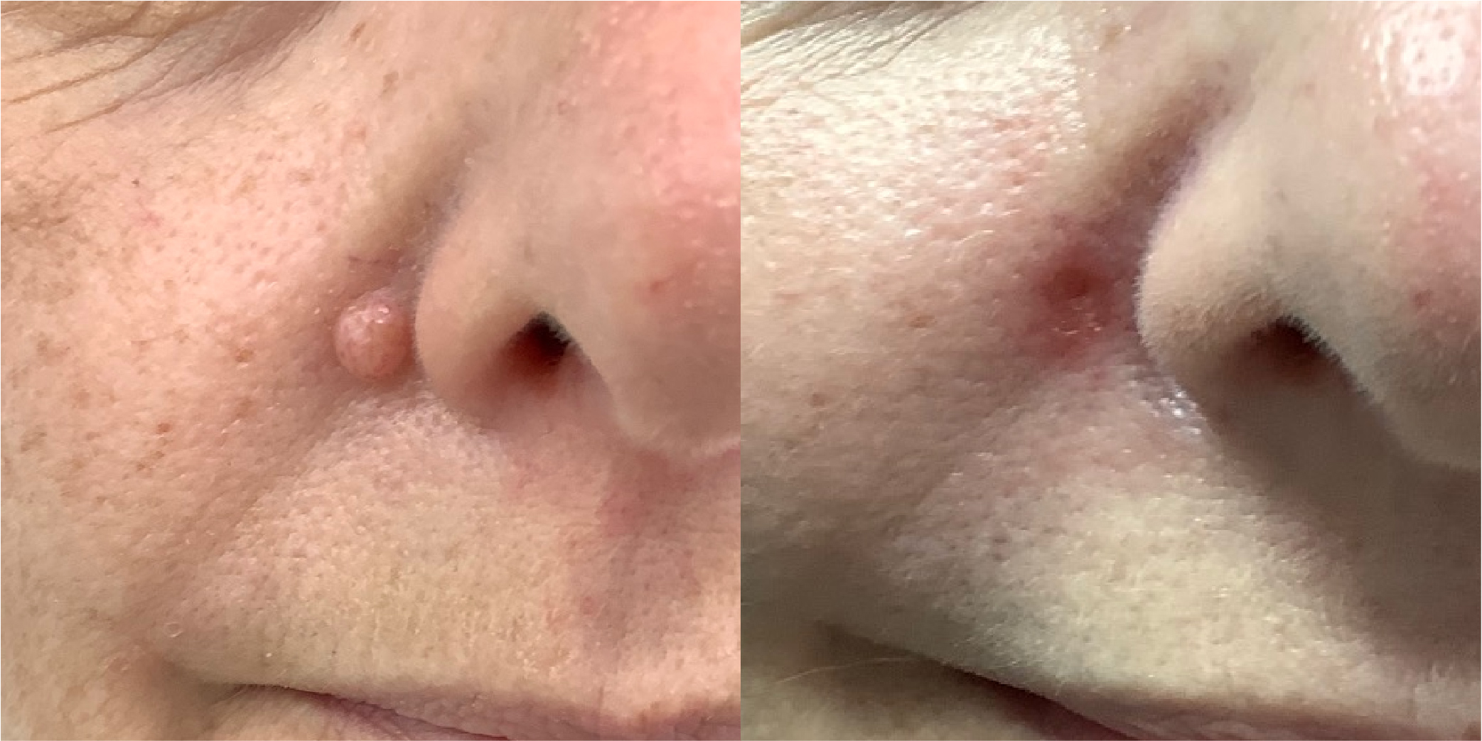 Laser Mole Removal Before & After Image