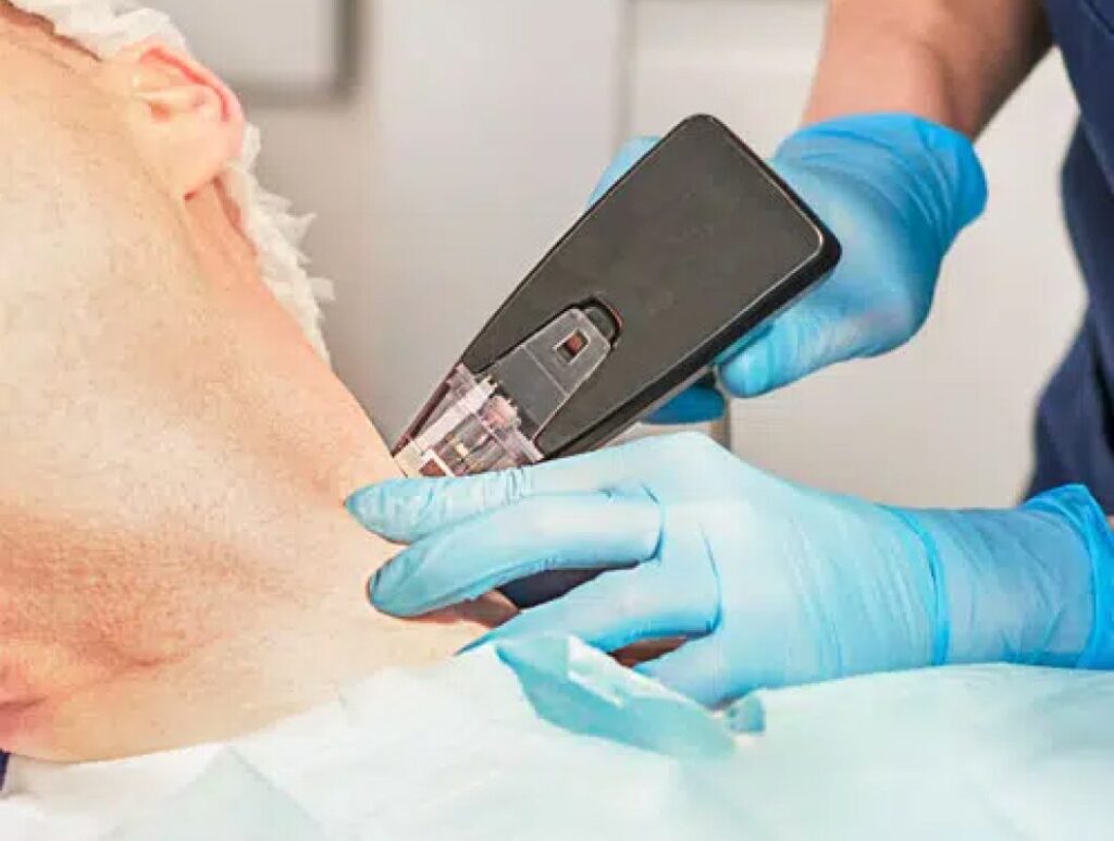 Morpheus8 Manchester