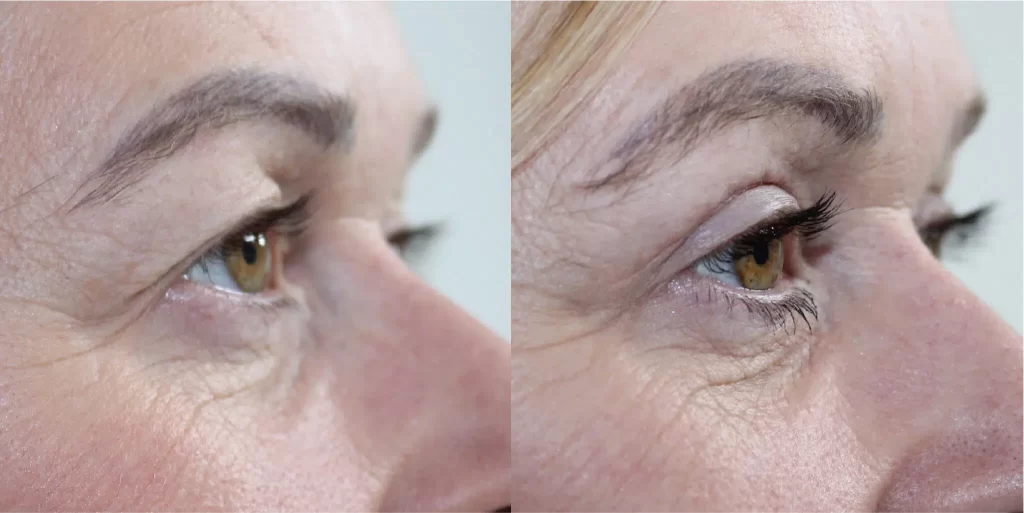 Blepharoplasty Manchester