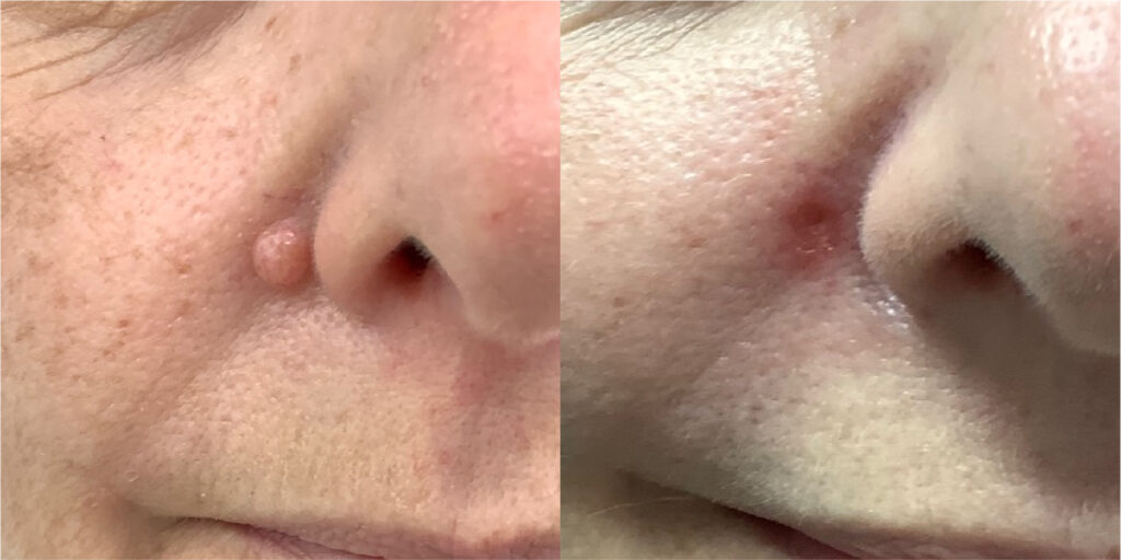 laser mole removal Manchester