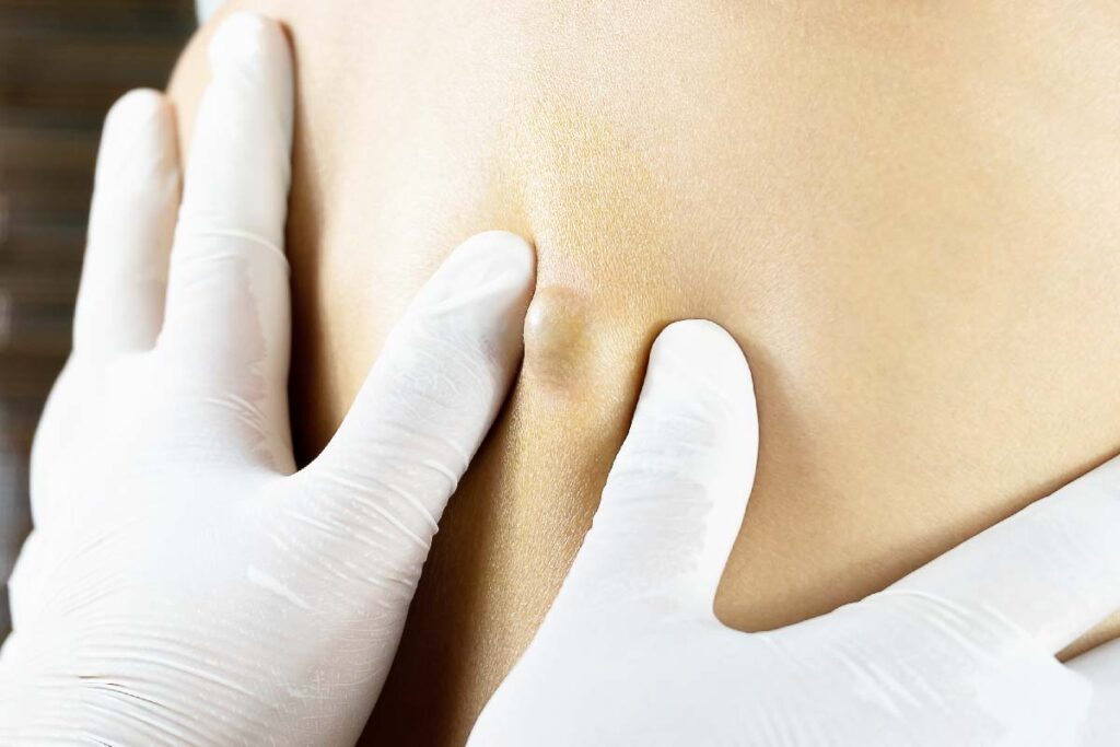 cyst removal manchester